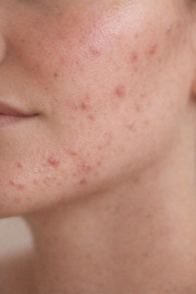 Acne & Breakouts