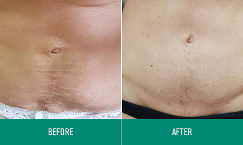 ONDO_before-and-after_3