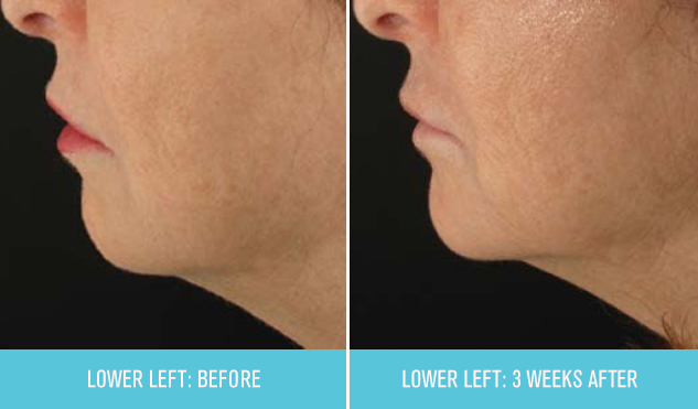 before-and-after_2_vF
