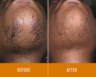 hair-removal_before-and-after_1