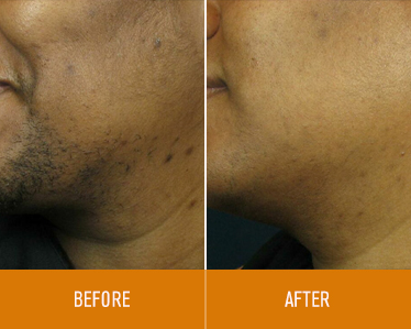 hair-removal_before-and-after_2
