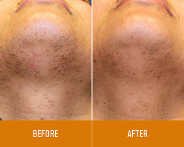 hair-removal_before-and-after_3