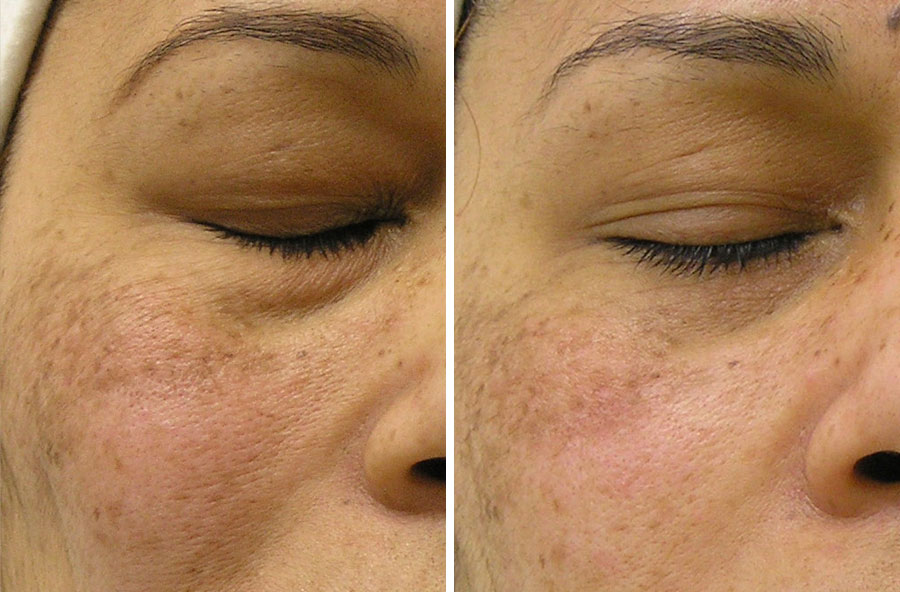 large-pores-dull-dry-skin_before-after