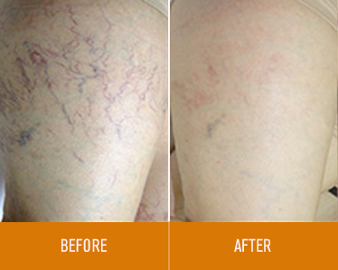 leg-vein-removal_before-and-after_1