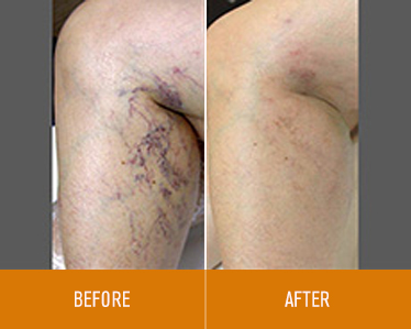 leg-vein-removal_before-and-after_2