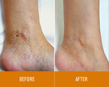 leg-vein-removal_before-and-after_3