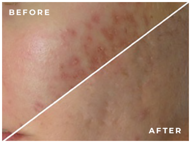 melasma-and-surgical-scars