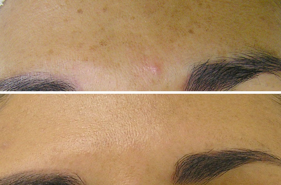 sun-damage-before-after
